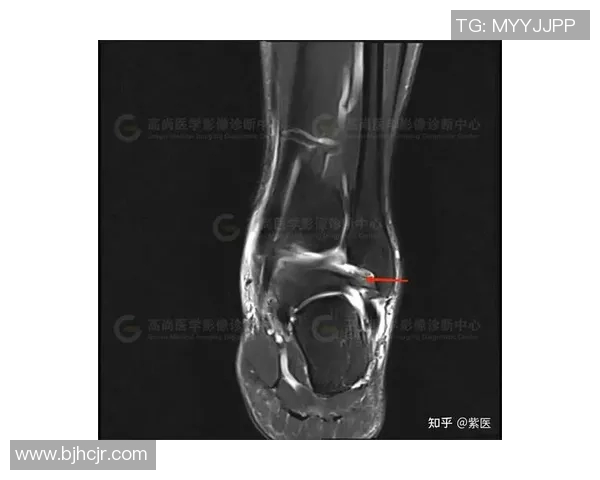林葳脚踝腓前韧带轻微撕裂预计康复期为一个月的详细分析与建议
